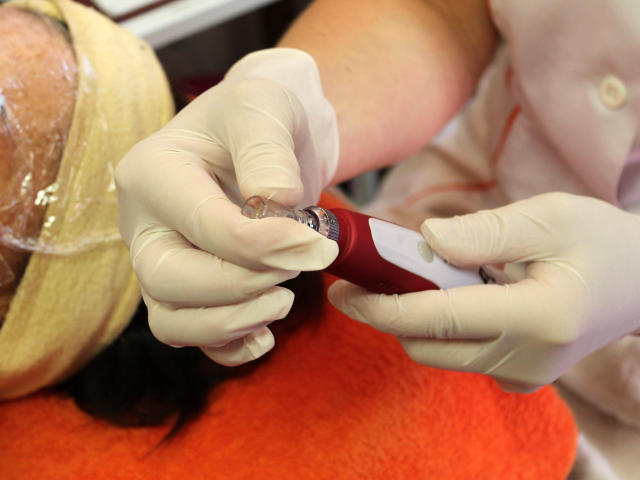 Mezoterapie v salónu krásy Dolce Diva Říčany