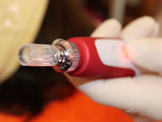 Mezoterapie v salónu krásy Dolce Diva Říčany