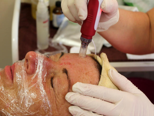 Mezoterapie v salónu krásy Dolce Diva Říčany