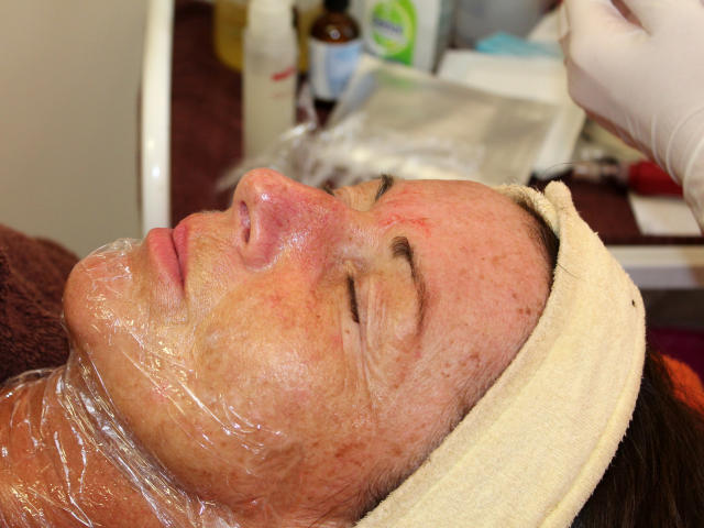 Mezoterapie v salónu krásy Dolce Diva Říčany