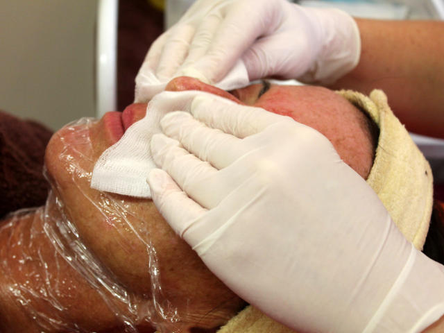 Mezoterapie v salónu krásy Dolce Diva Říčany