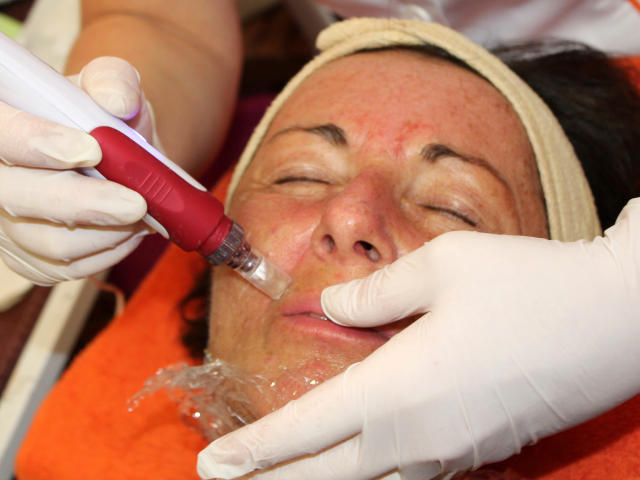 Mezoterapie v salónu krásy Dolce Diva Říčany