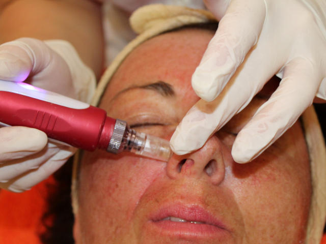 Mezoterapie v salónu krásy Dolce Diva Říčany