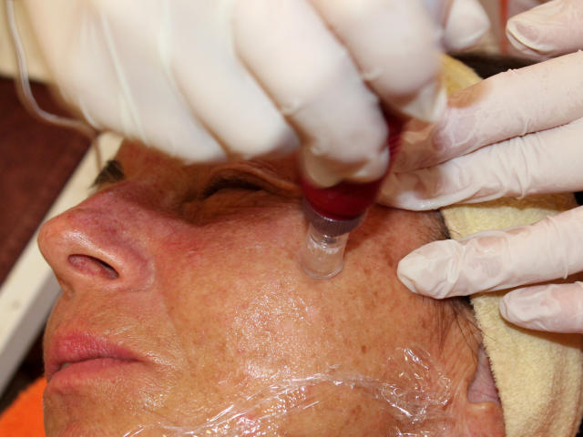 Mezoterapie v salónu krásy Dolce Diva Říčany