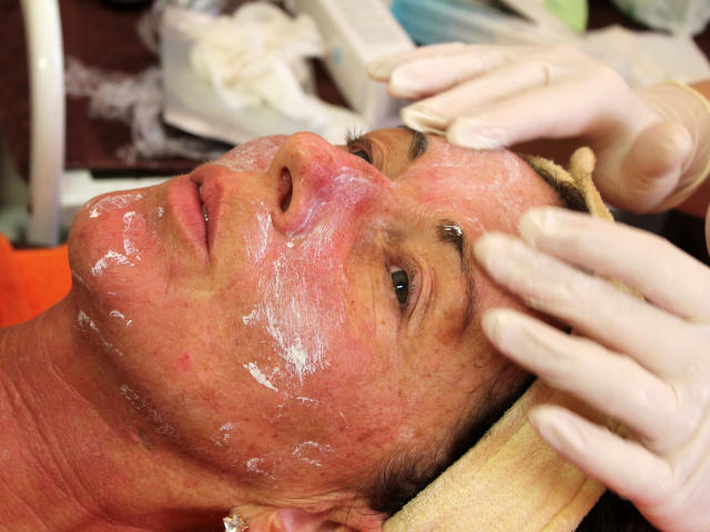 Mezoterapie v salónu krásy Dolce Diva Říčany