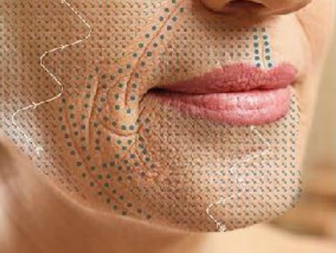 Plasma Pen Fibroblast Plasma Pen Fibroblast