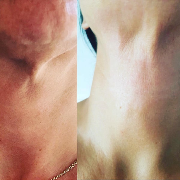 Plasma Pen Fibroblast - krk před a po