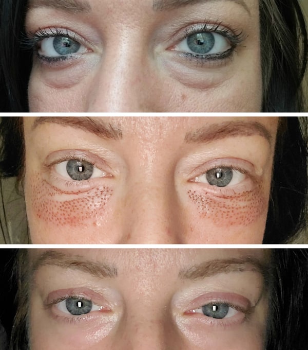 Plasma pen fibroblast - oční vrásky - před a po