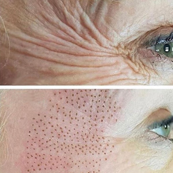 Plasma Pen Fibroblast - kruhy pod očima - před a po