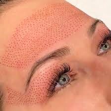 Plasma Pen Fibroblast