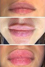 Plasma Pen Fibroblast