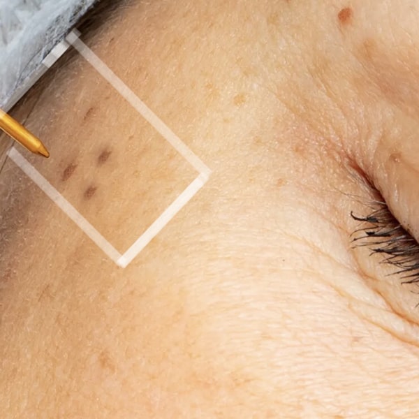 Plasma Pen Fibroblast