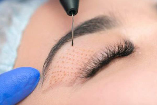 Plasma Pen Fibroblast Plasma Pen Fibroblast